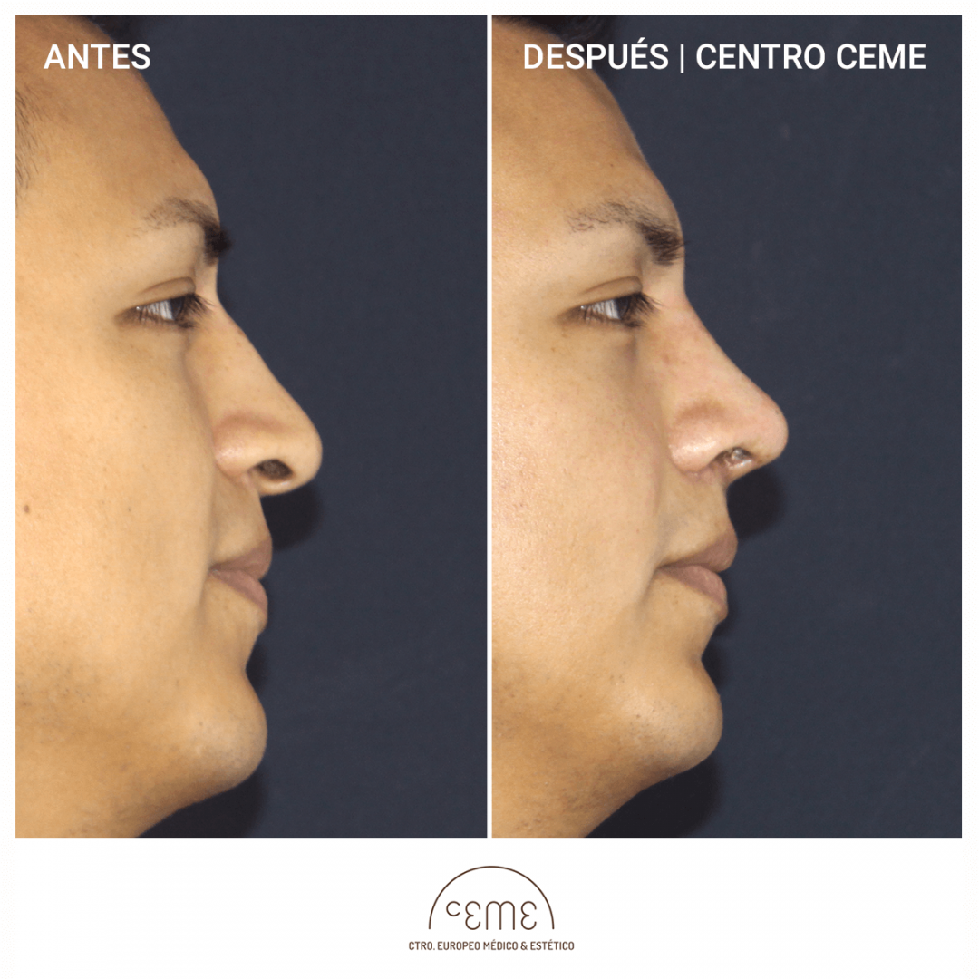 Rinoplastia Ceme