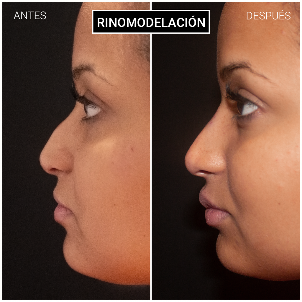 Rinoplastia o Rinomodelación Ceme