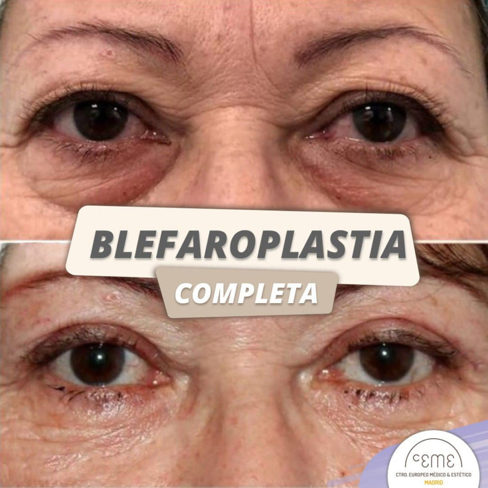 Blefaroplastia Antes y Después Ceme