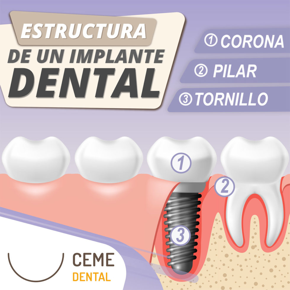 Implante Dental Precio y todo lo que tienes que saber Ceme