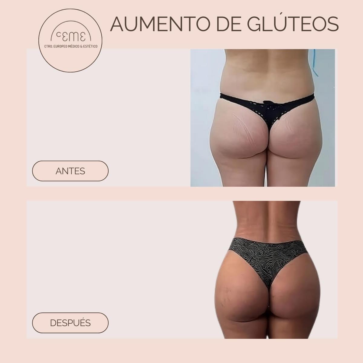 Aumento y modelado de glúteos – Clínica Arquero